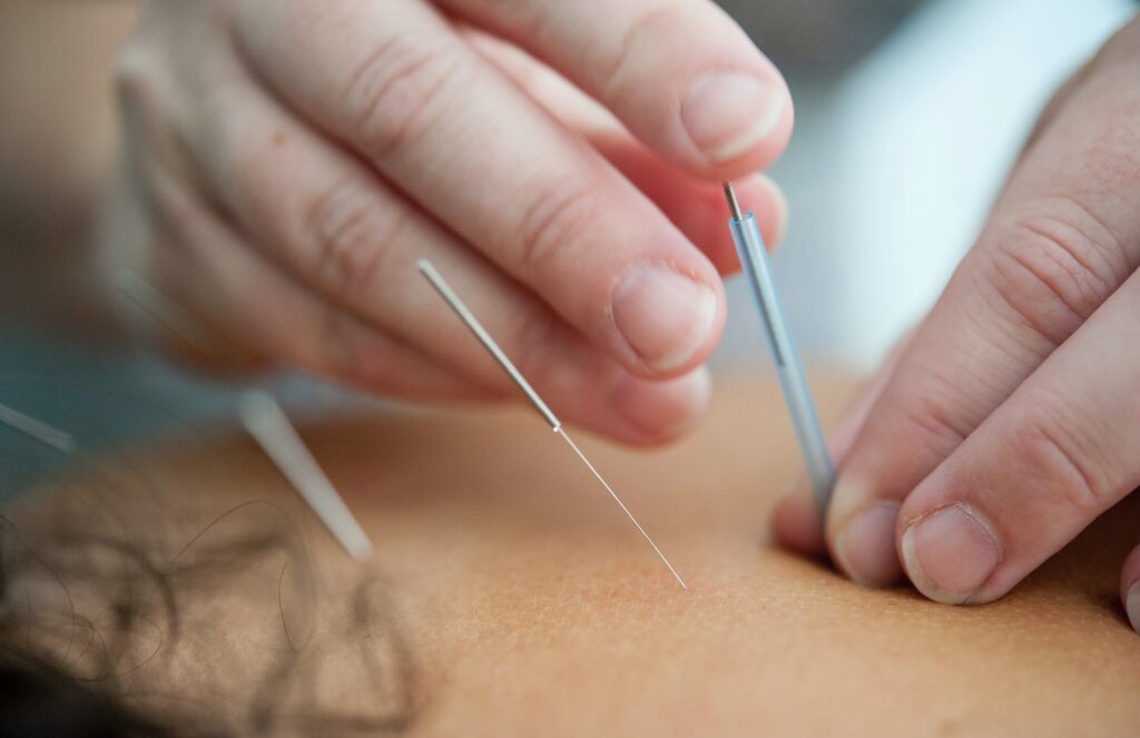 Bilde av akupunktur