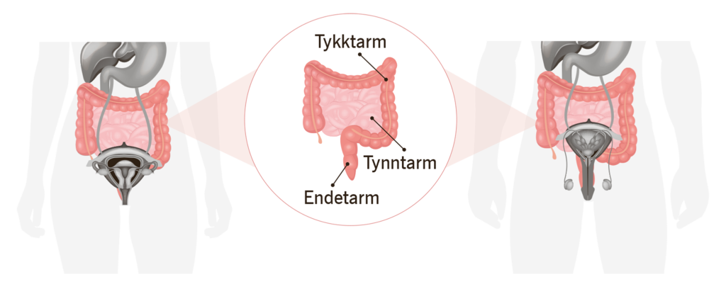 Illustrasjon som viser hvor tarmene ligger i magen og hvor tarmkreft kan oppstå