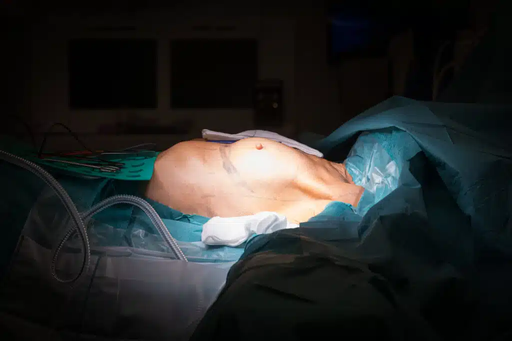 En pasient som gjennomgår en brystforstørrelsesoperasjon ligger på et operasjonsbord, dekket av kirurgiske gardiner med kirurgiske instrumenter i nærheten.