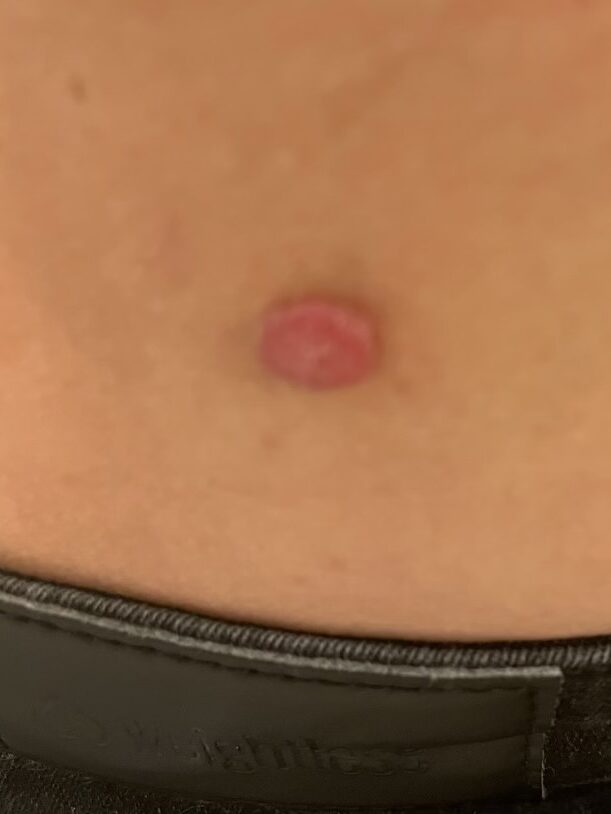 Nærbilde av en liten, rund, hevet, rosa kule på huden nær linningen på svarte bukser. Dette er et melanom (føflekkreft).