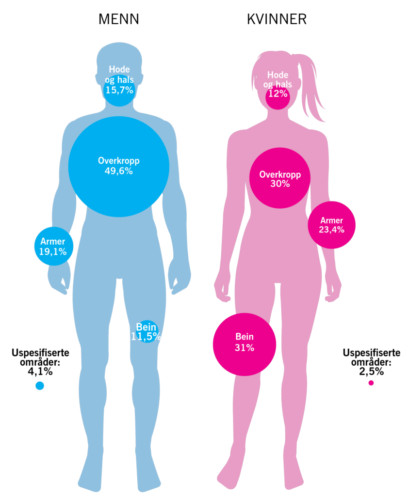 Infografikk som viser fordelingen av føflekkreft på menn og kvinner, med prosentandeler for hode, overkropp, armer, ben og uspesifiserte områder. Tekst på norsk.