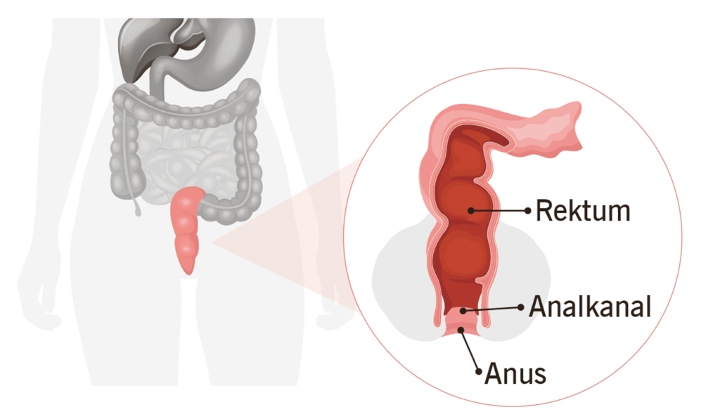 Diagram over menneskets fordøyelseskanal med endetarm, analkanal og anus, med merkede utsnitt på tysk og fokus på analkreft.