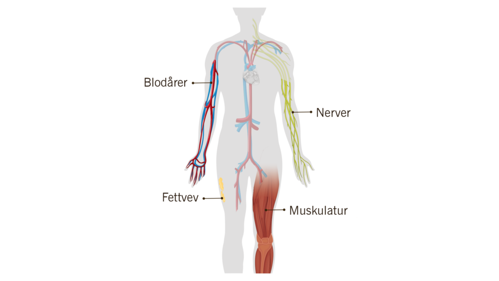 Skisse av menneskekroppen med blodårer, nerver, fettvev, muskler og områder berørt av kul kreft i armer og ben, med norske betegnelser for hver struktur.